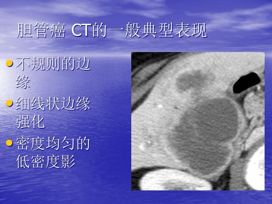 【关于胆】胆管癌的CT诊断_第5页