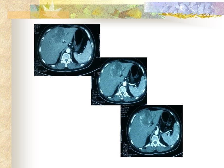 【关于胆】肝内胆管细胞癌：病例讨论_第5页