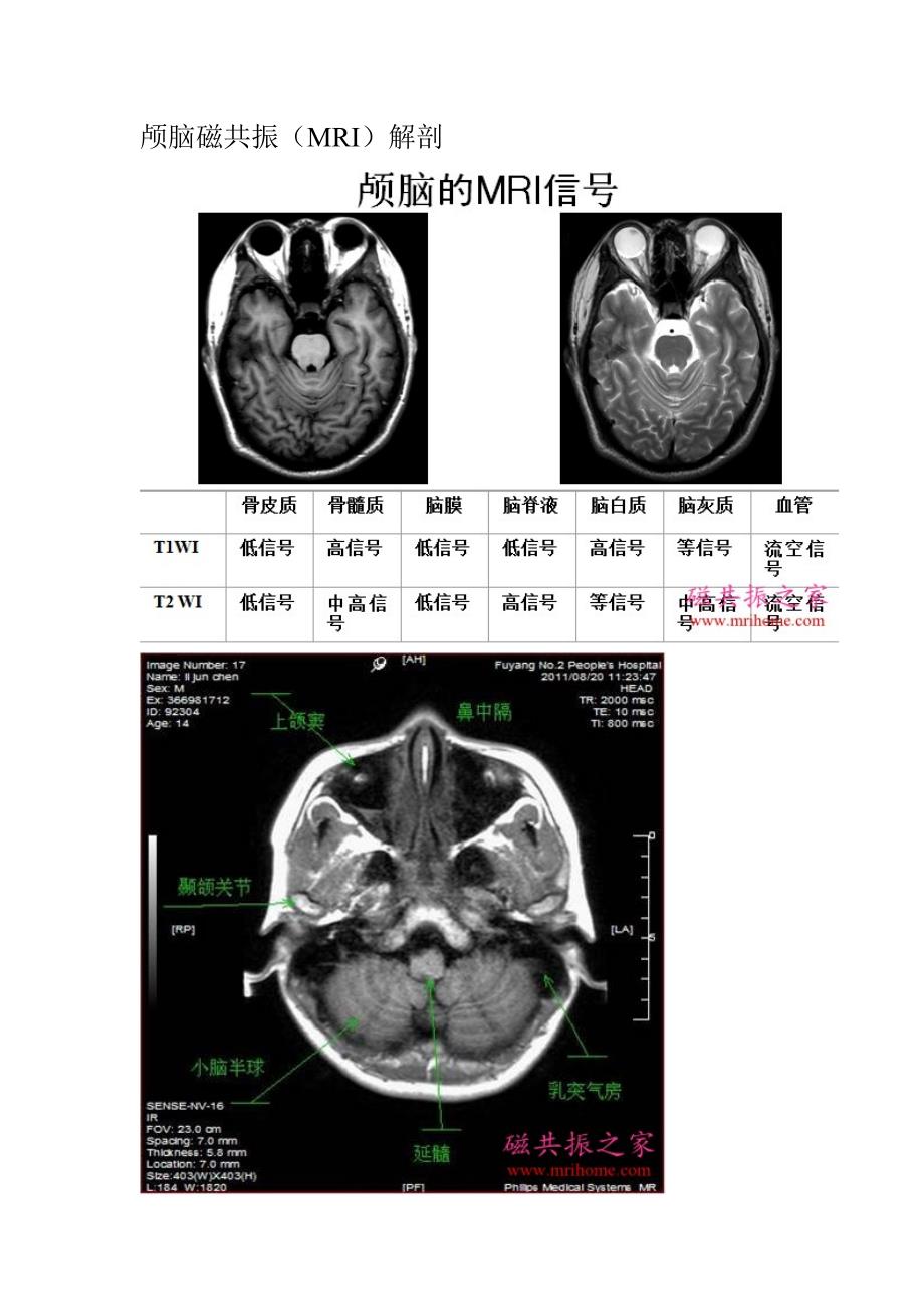 颅脑轴位MRI解剖.doc_第1页