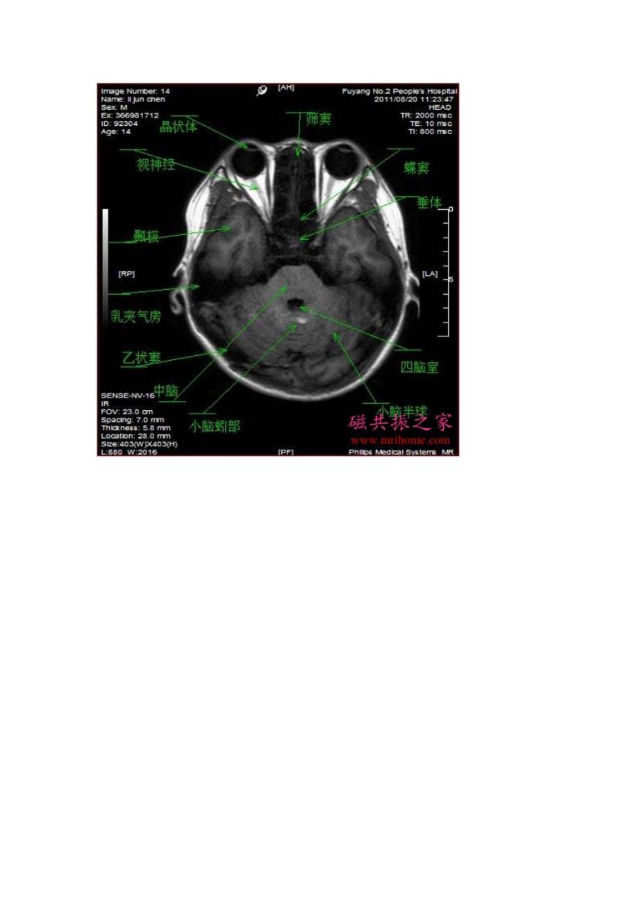 颅脑轴位MRI解剖.doc_第2页
