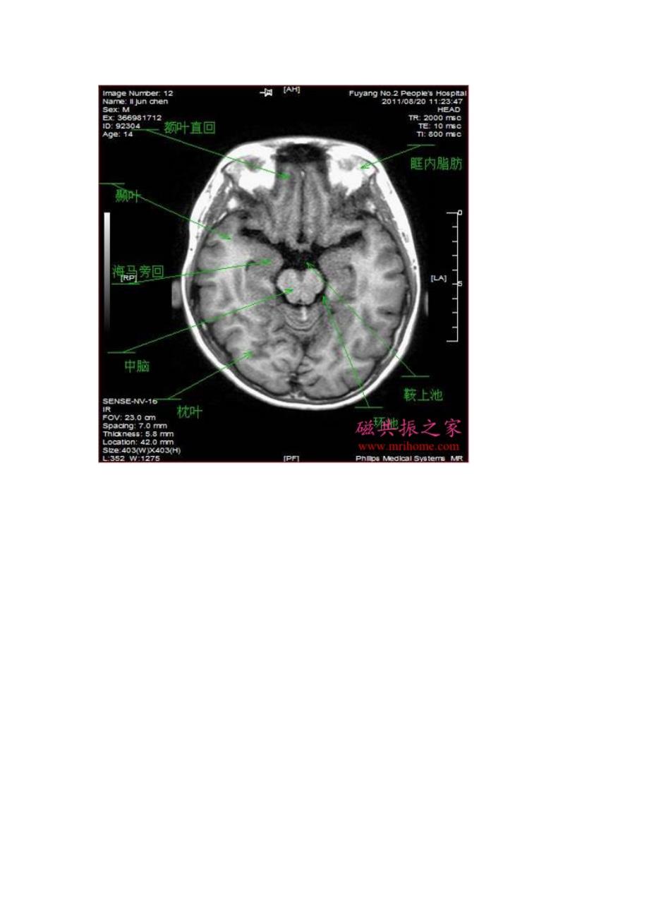 颅脑轴位MRI解剖.doc_第4页