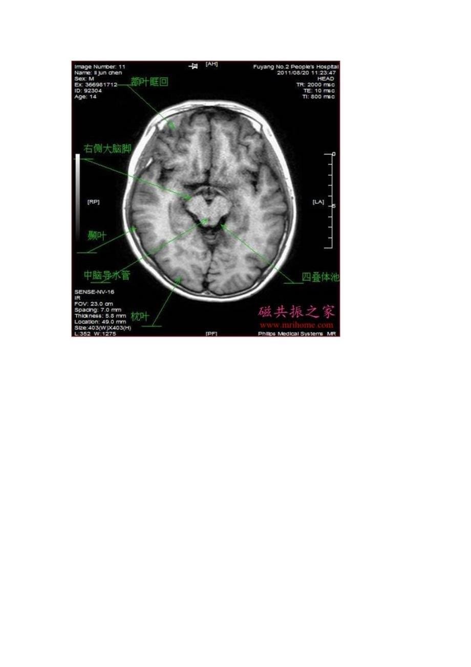 颅脑轴位MRI解剖.doc_第5页