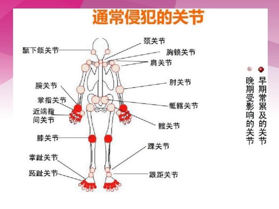 类风湿性关节炎的X线诊断.ppt_第5页