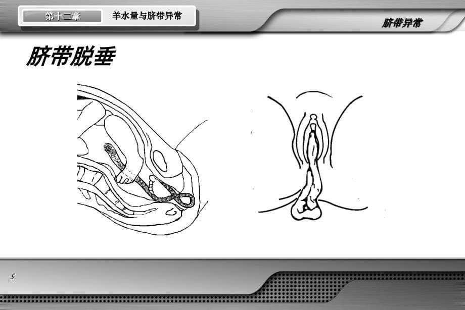 妇产科学(第8版)第十二章第三节脐带异常_第5页