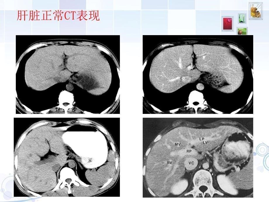 肝胆脾胰疾病实习.pdf_第5页