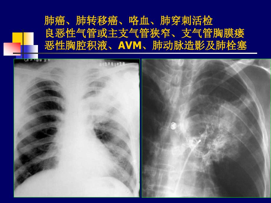 介入治疗课件胸腹部-潘德超_第2页