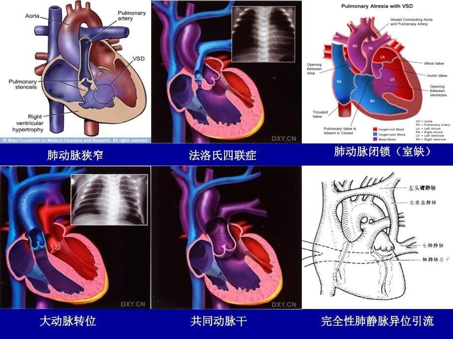 课件：心脏病的外科治疗_第5页