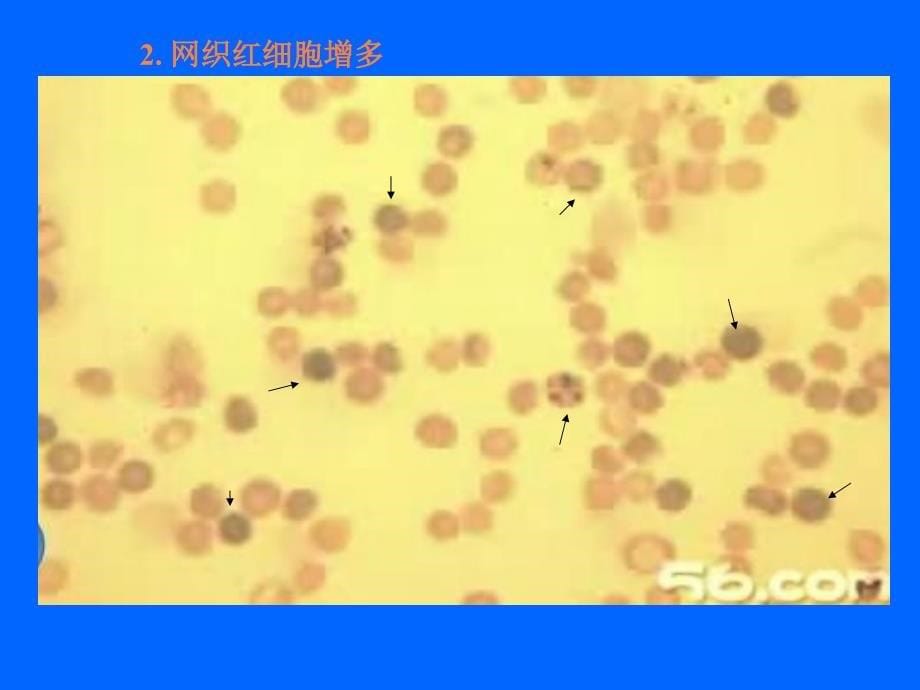 课件：缺铁性贫血骨髓象特点_第5页