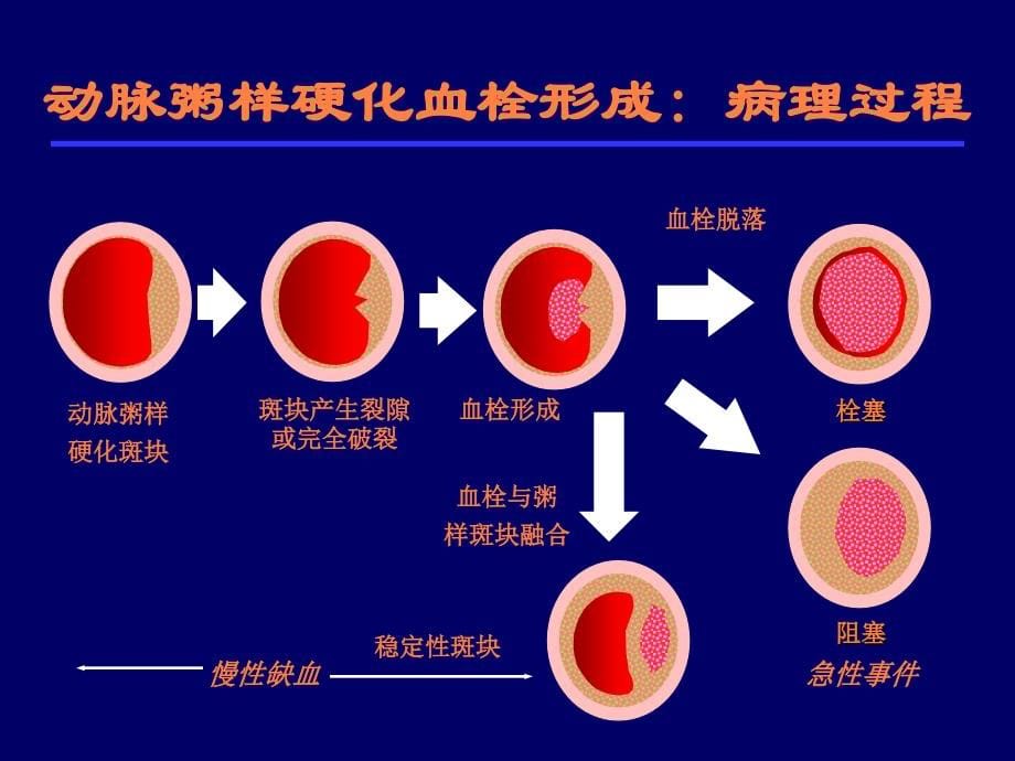 课件：急性脑梗死的溶栓及抗栓治疗_第5页