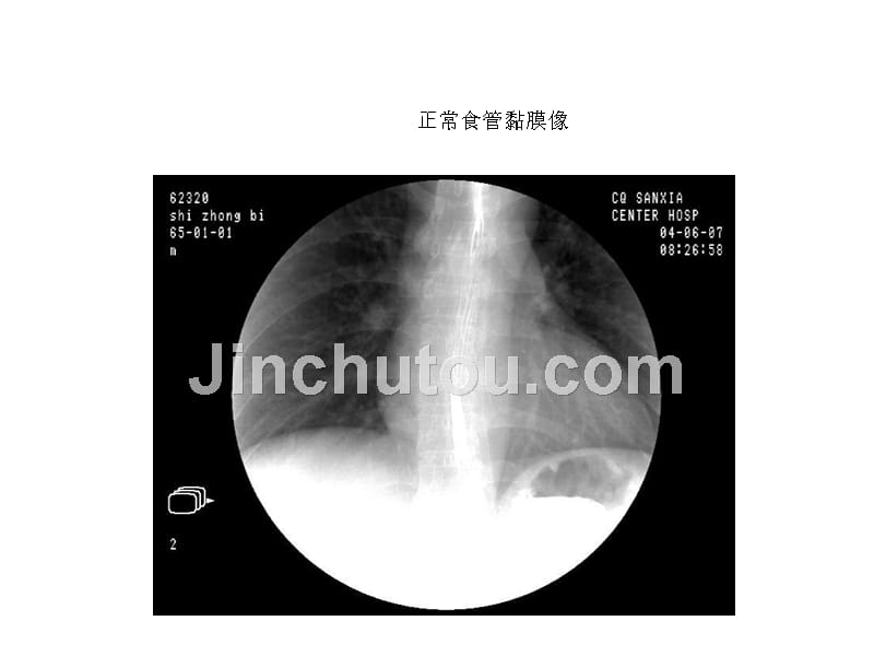 课件：影像全套消化道钡餐_第2页