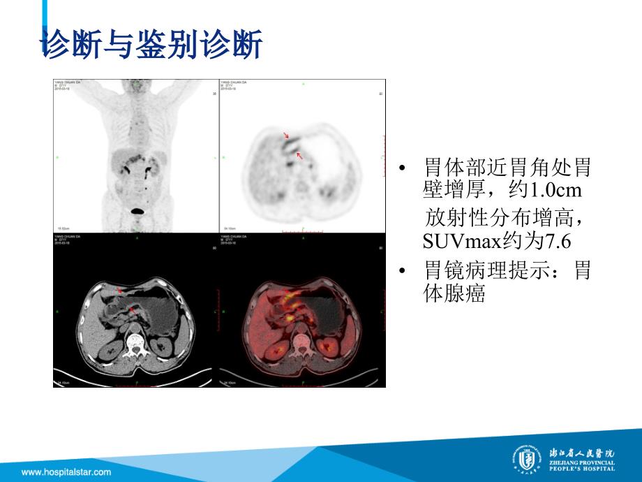 petct在胃癌中的临床应用_第4页