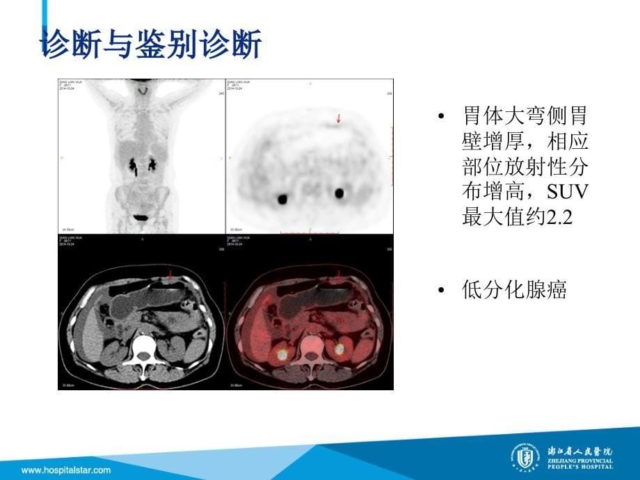 petct在胃癌中的临床应用_第5页