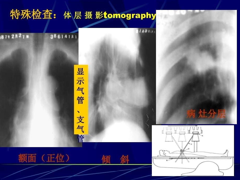 医学影像学呼吸系统授课_第5页