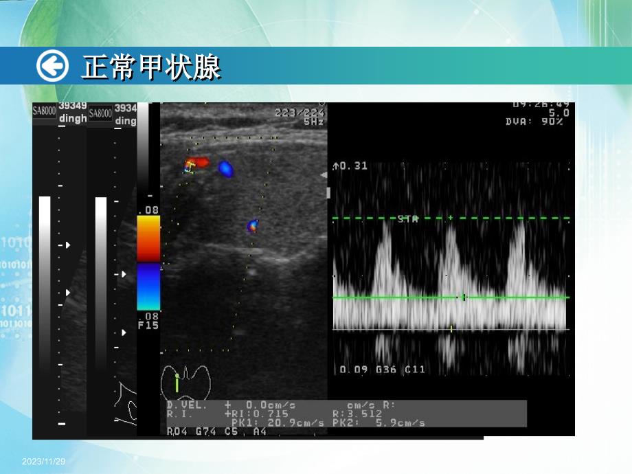 浅表器官超声诊断示教_第3页