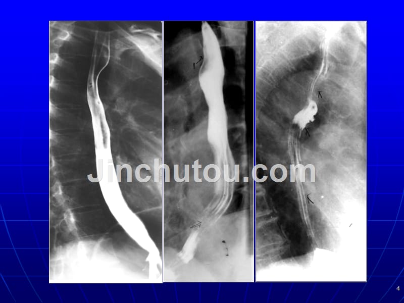 医学影像学第六章消化系统和腹膜腔_第4页