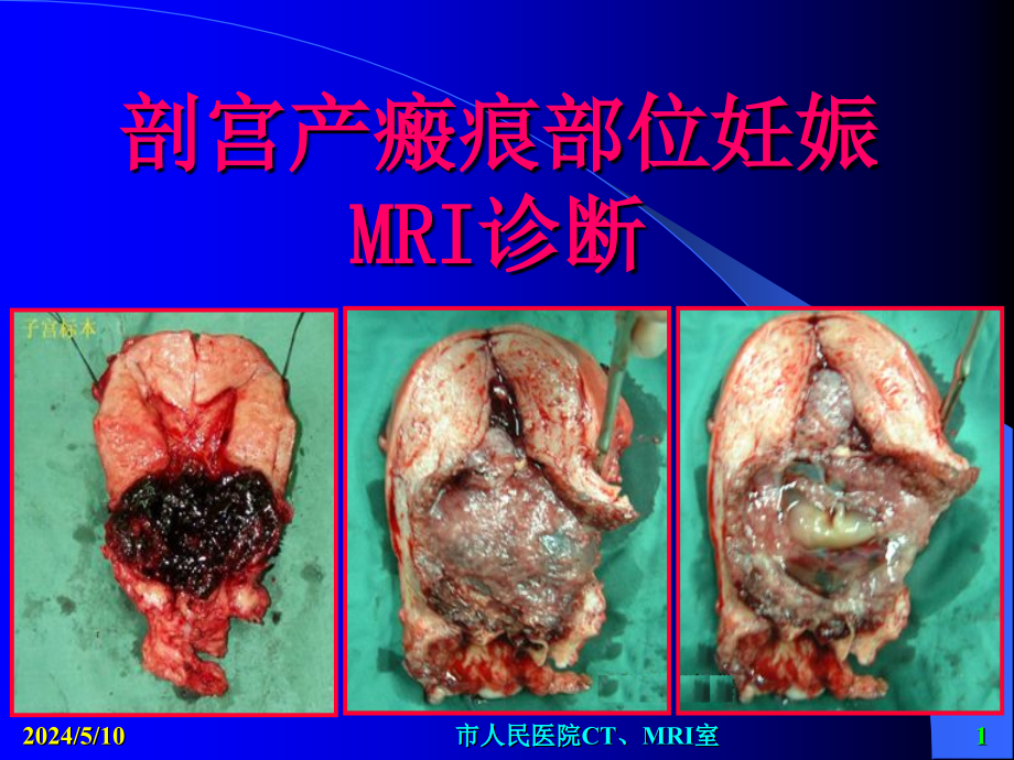 剖宫产子宫疤痕妊娠mri_第1页