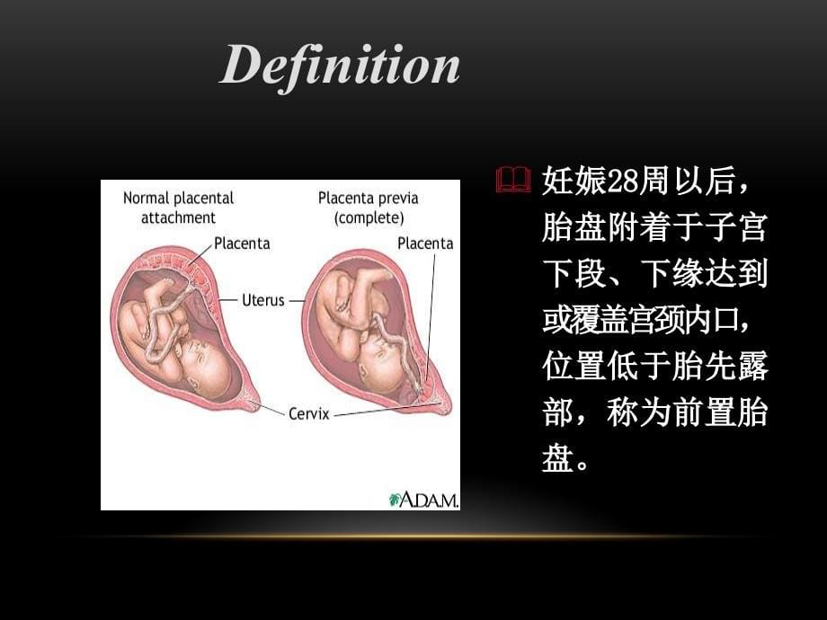 前置胎盘（教案）的诊断预防和处理_第5页