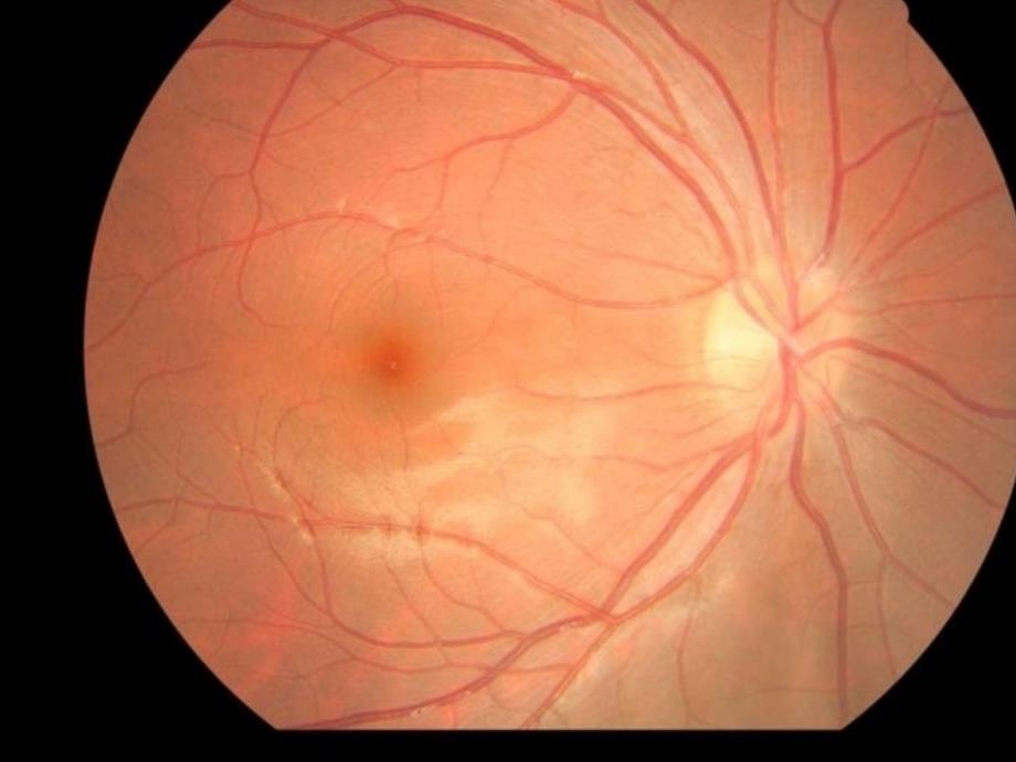 糖尿病性视网膜病变的眼部表现_第3页