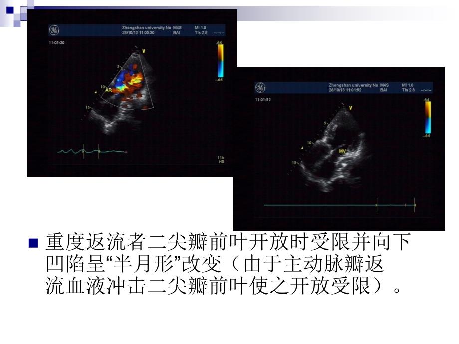 心脏瓣膜病的超声诊断第三部分_第3页