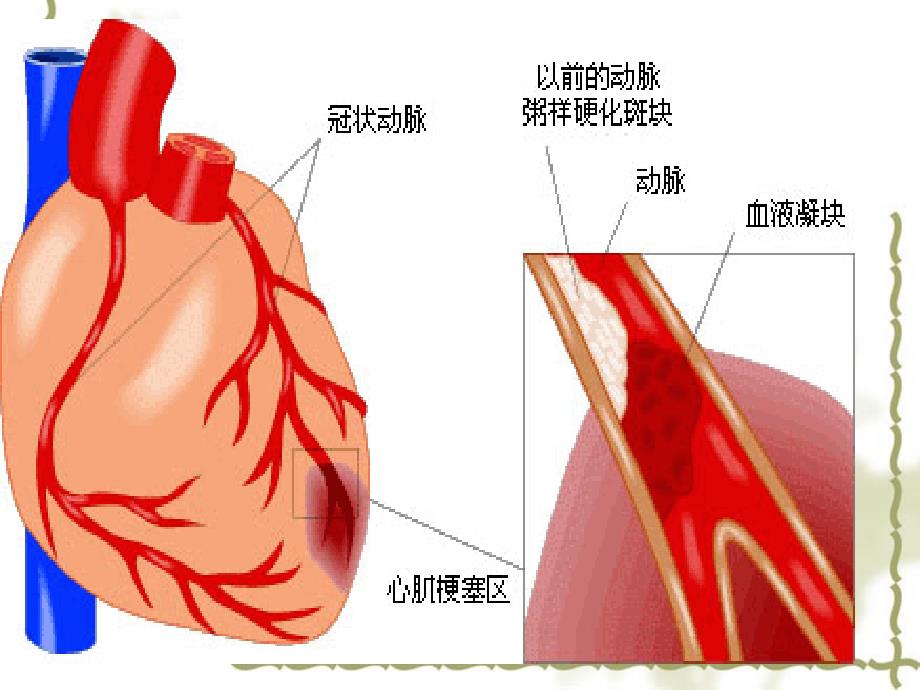 心梗的急救_第2页