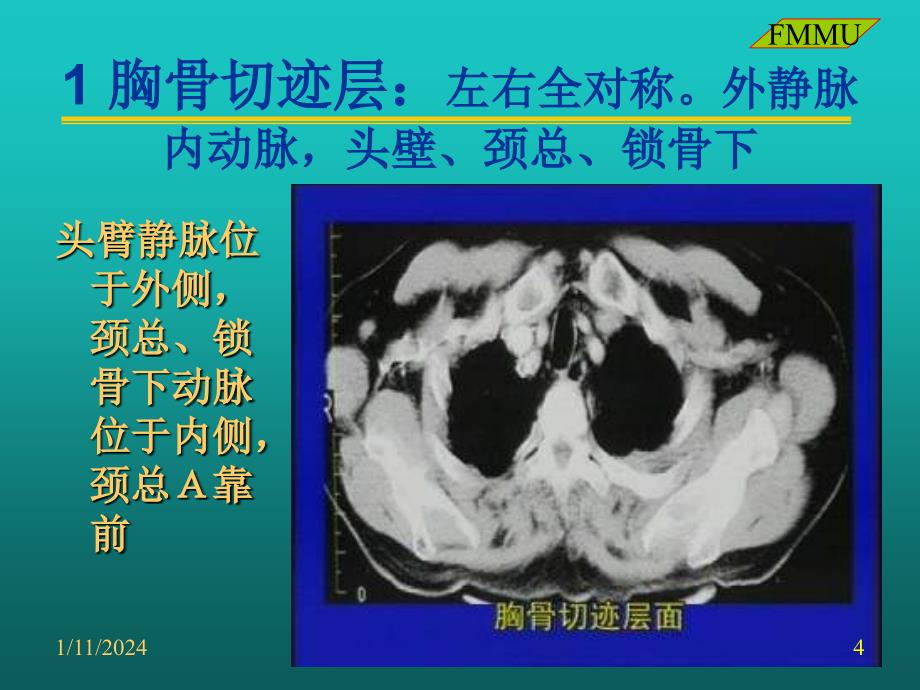 ct(胸部)读片(西京医院)_第4页