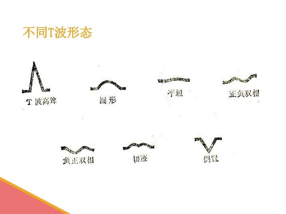 心电图基础知识1_第5页