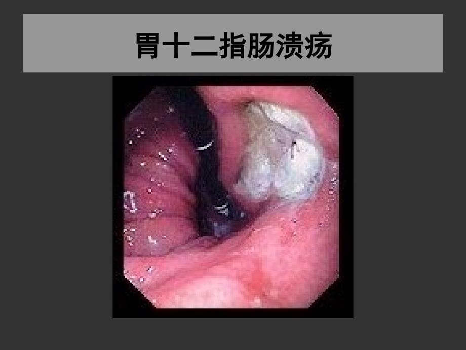 上海交大外科学胃十二指肠溃疡_第2页