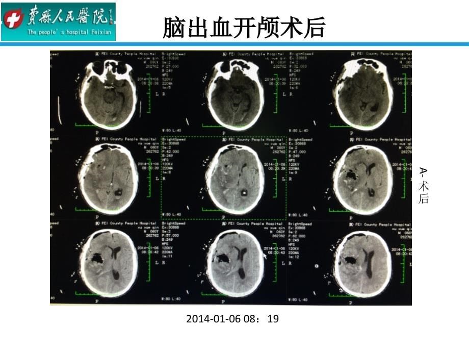 微创穿刺引流术治疗高血压性脑出血_第5页