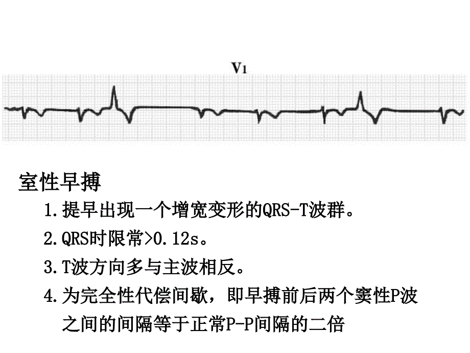 心脏扑动、颤动和传导阻滞心电图-(2)_第4页