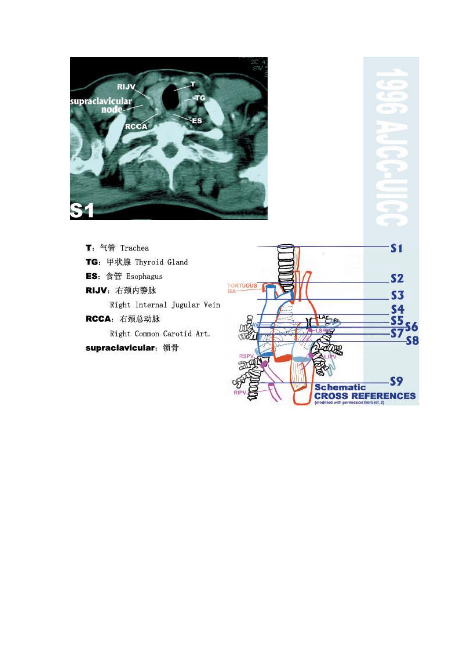 纵膈淋巴结分区  最新版图谱_第2页