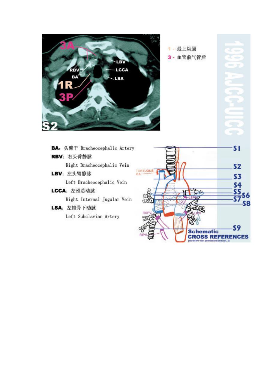 纵膈淋巴结分区  最新版图谱_第3页