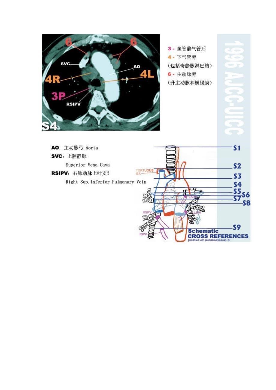 纵膈淋巴结分区  最新版图谱_第5页