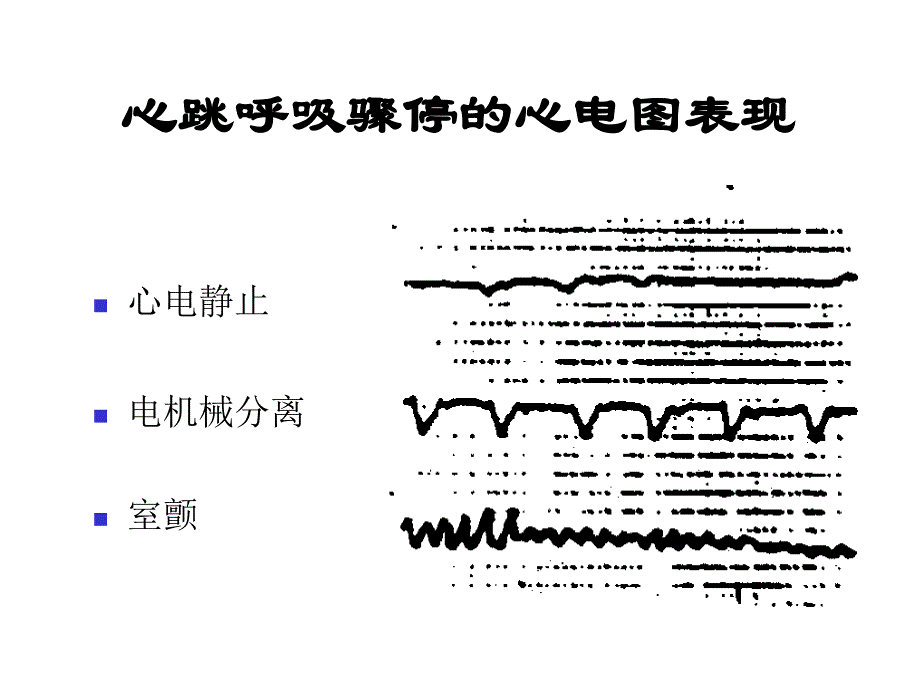 心肺脑复苏(讲课用)_第4页