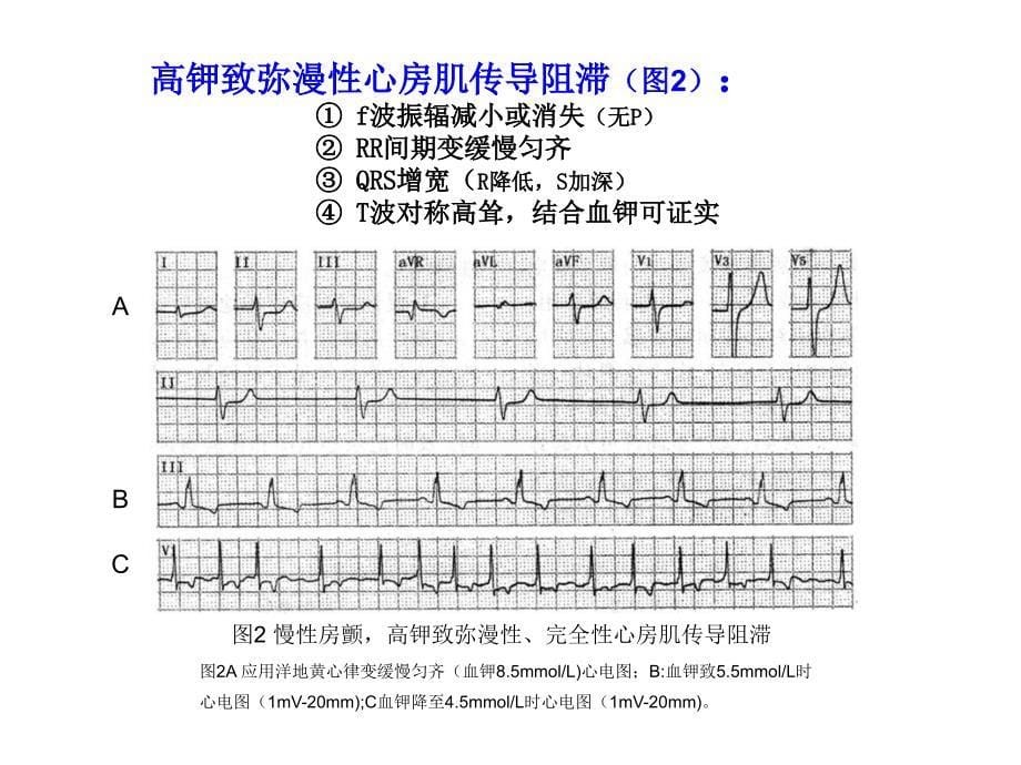 心房颤动心电图诊断难点2011.4.6改_第5页