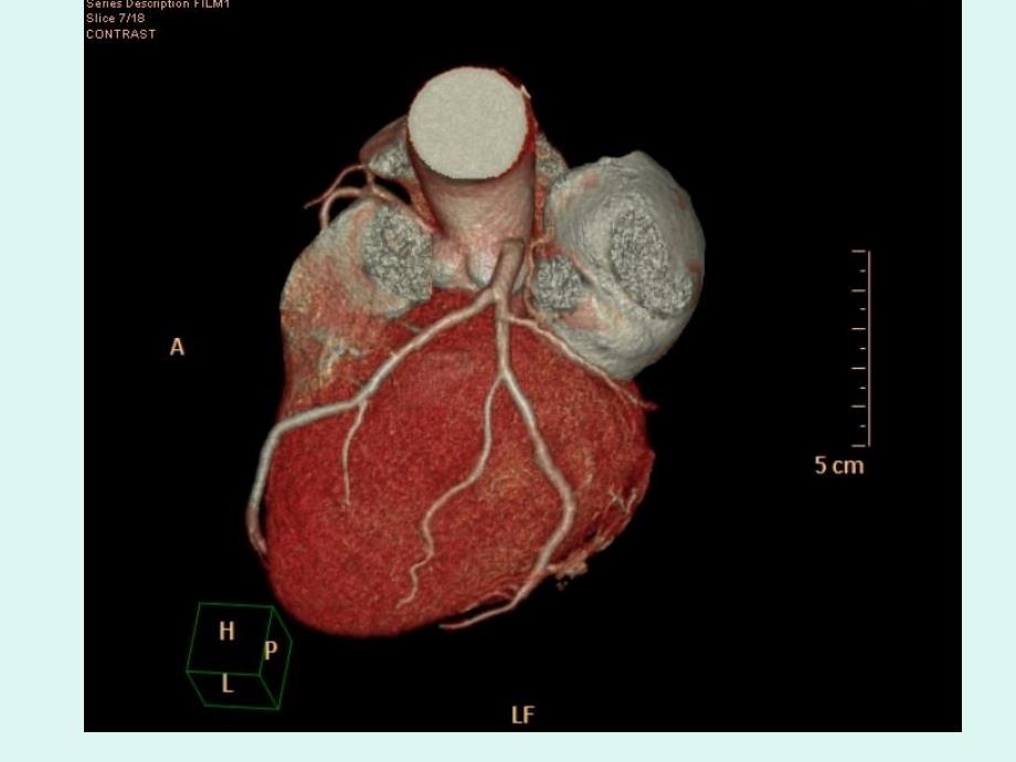 心脏冠状动脉cta成_第4页