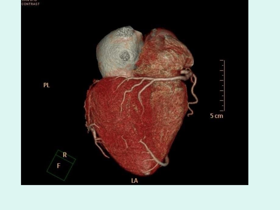 心脏冠状动脉cta成_第5页