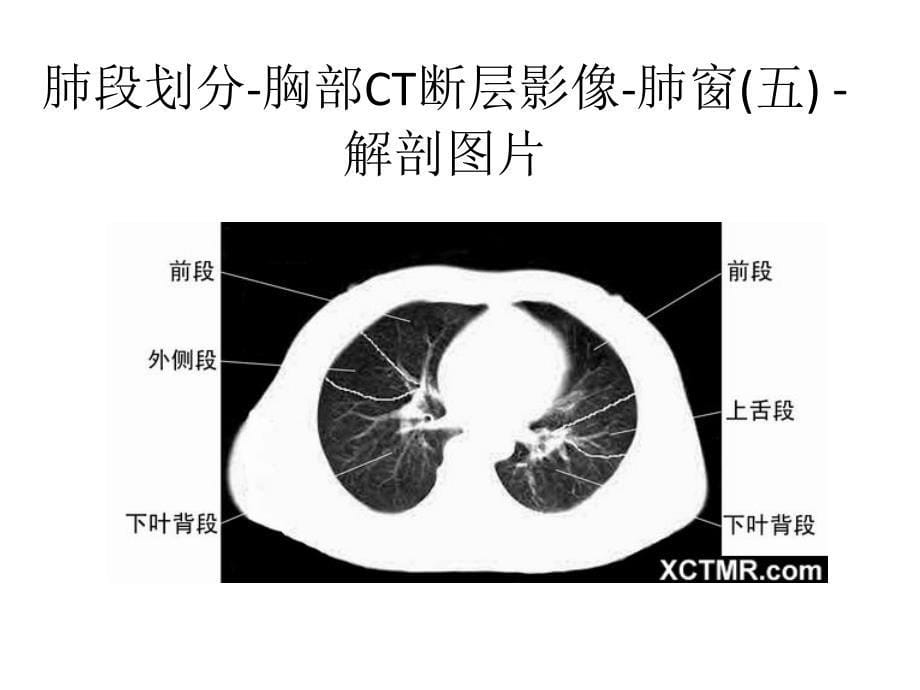 胸部ct肺段划分_第5页