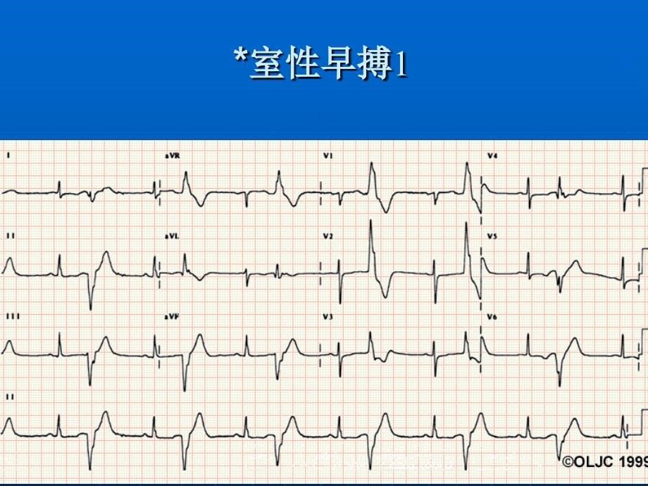 心电图识记_第5页