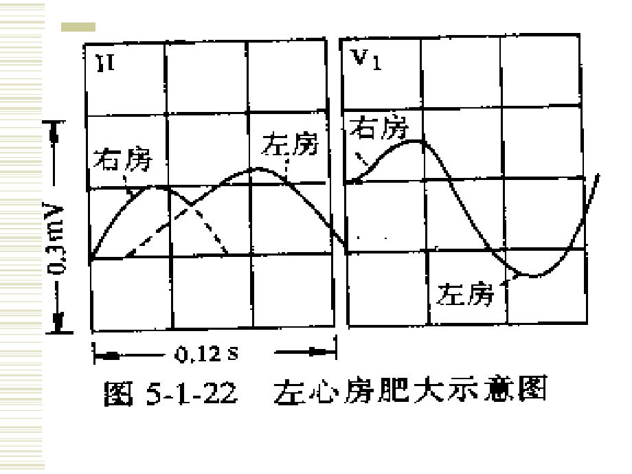 心电图讲稿4_第3页