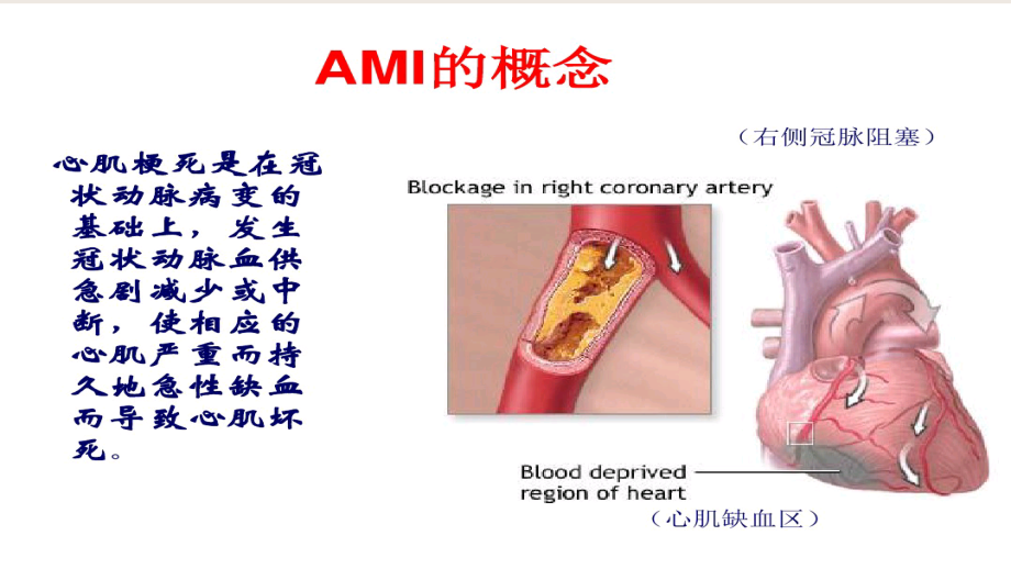 急性心肌梗死的院前急救-张学军_第2页