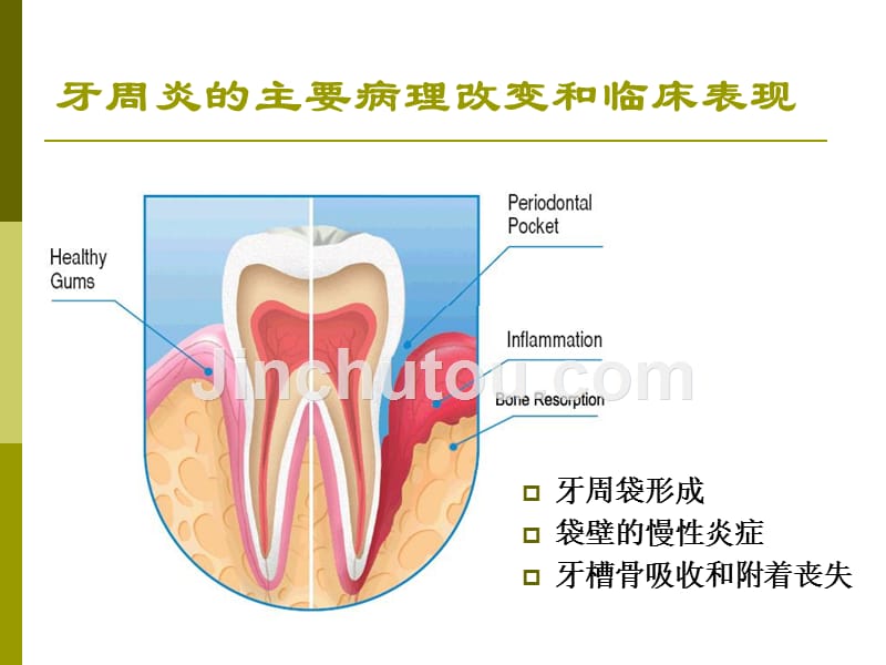 牙周炎的伴发病变_第1页