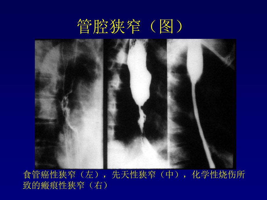 医学影像学胃肠道疾病_第4页