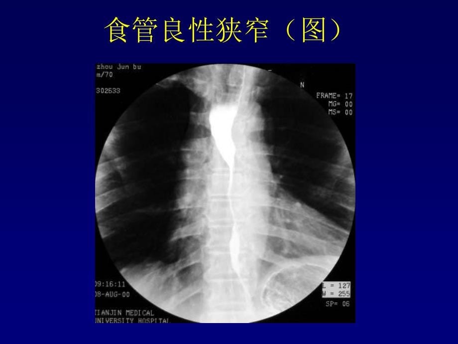 医学影像学胃肠道疾病_第5页