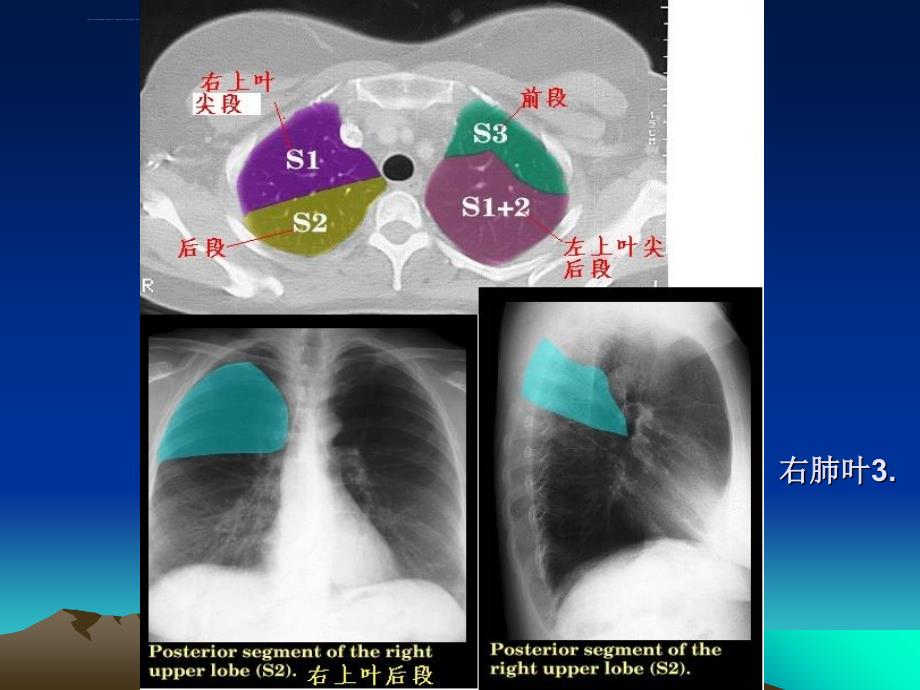 肺段ct彩色-解剖图_第4页