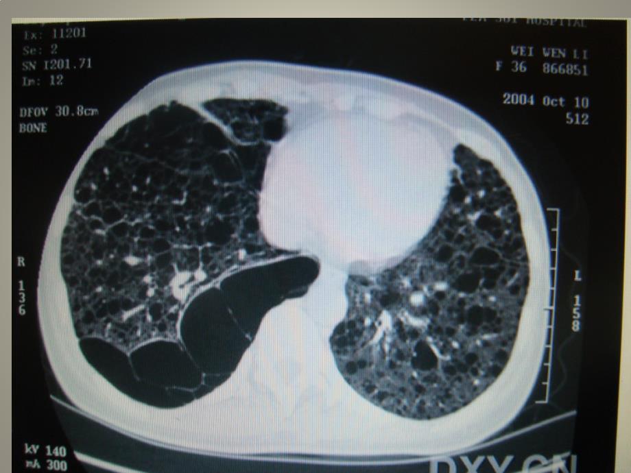 肺淋巴管平滑肌瘤的_第3页