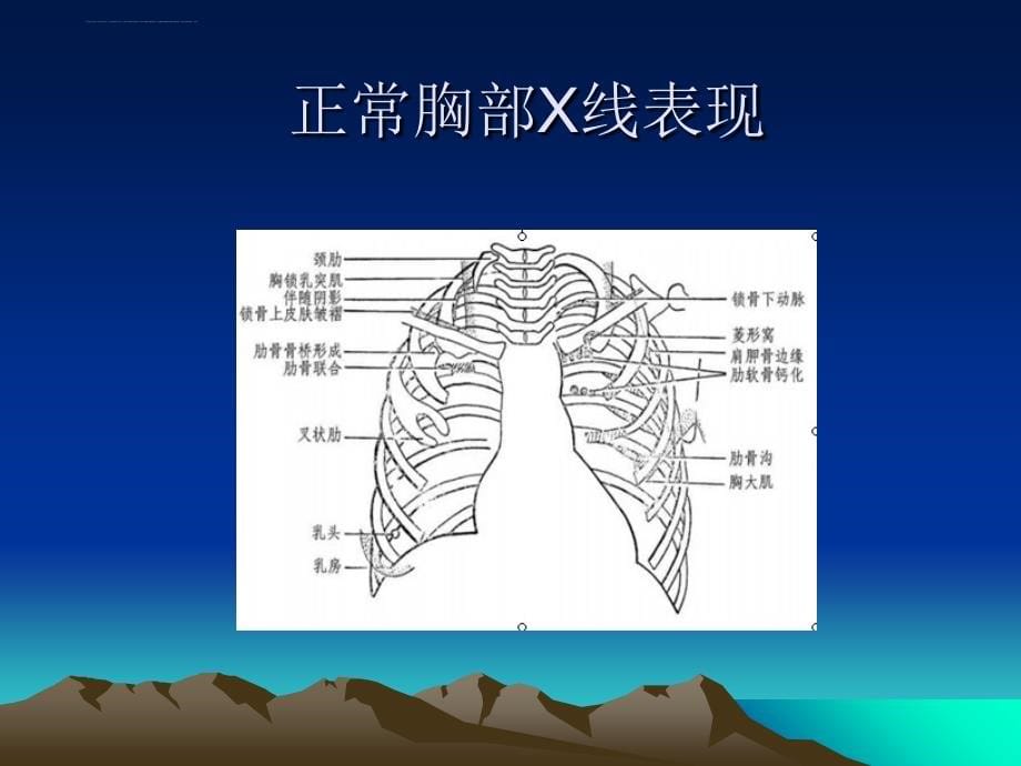 呼吸系统常见病x线表现教案指南课件_第5页