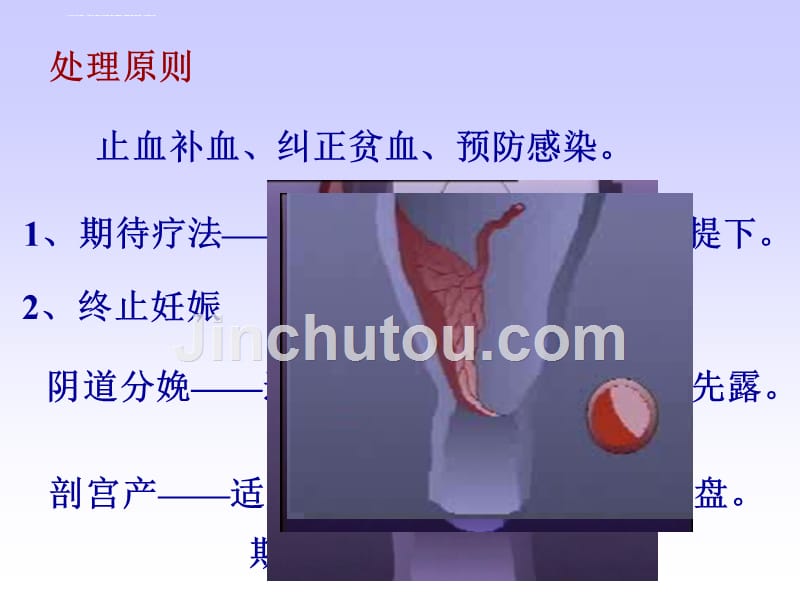 妊娠晚期出血性疾病课件_第4页