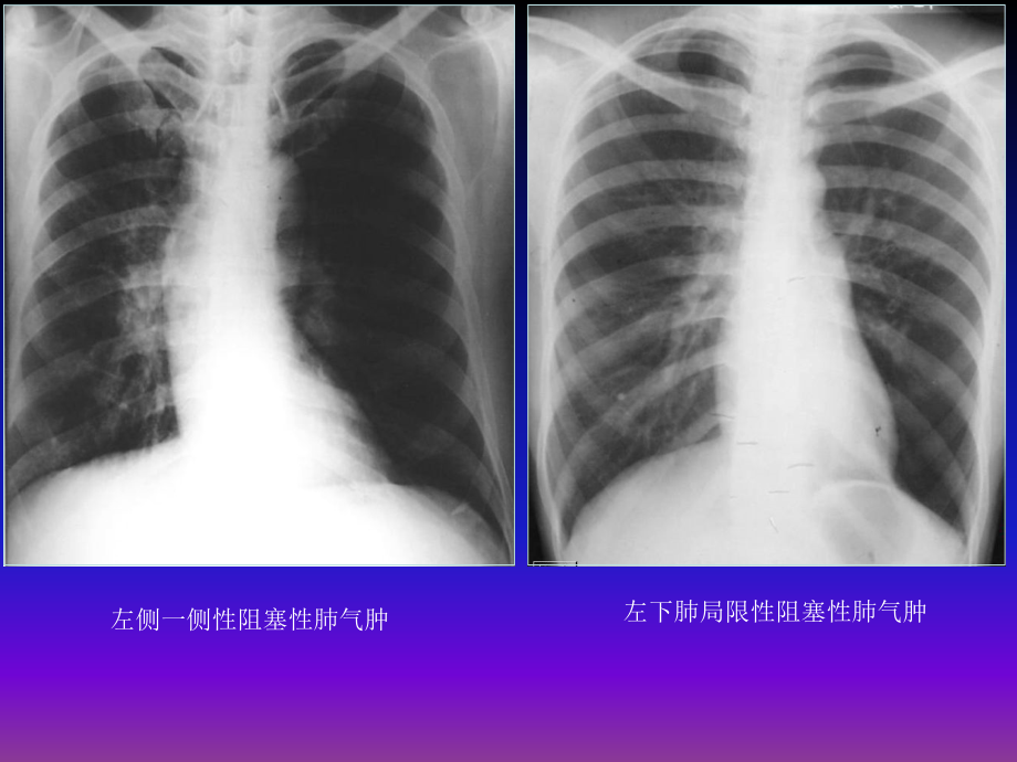 呼吸系统x线基本病变课件_第3页