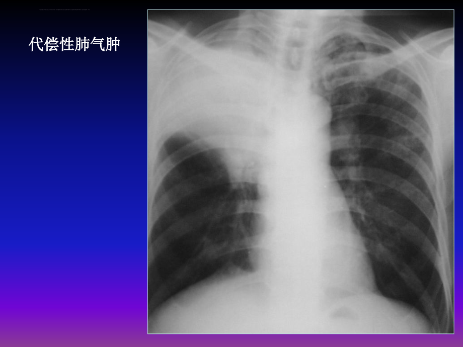 呼吸系统x线基本病变课件_第4页