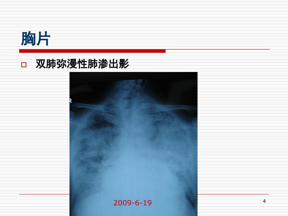 ards的机械通气治疗(rt培训)课件_第4页